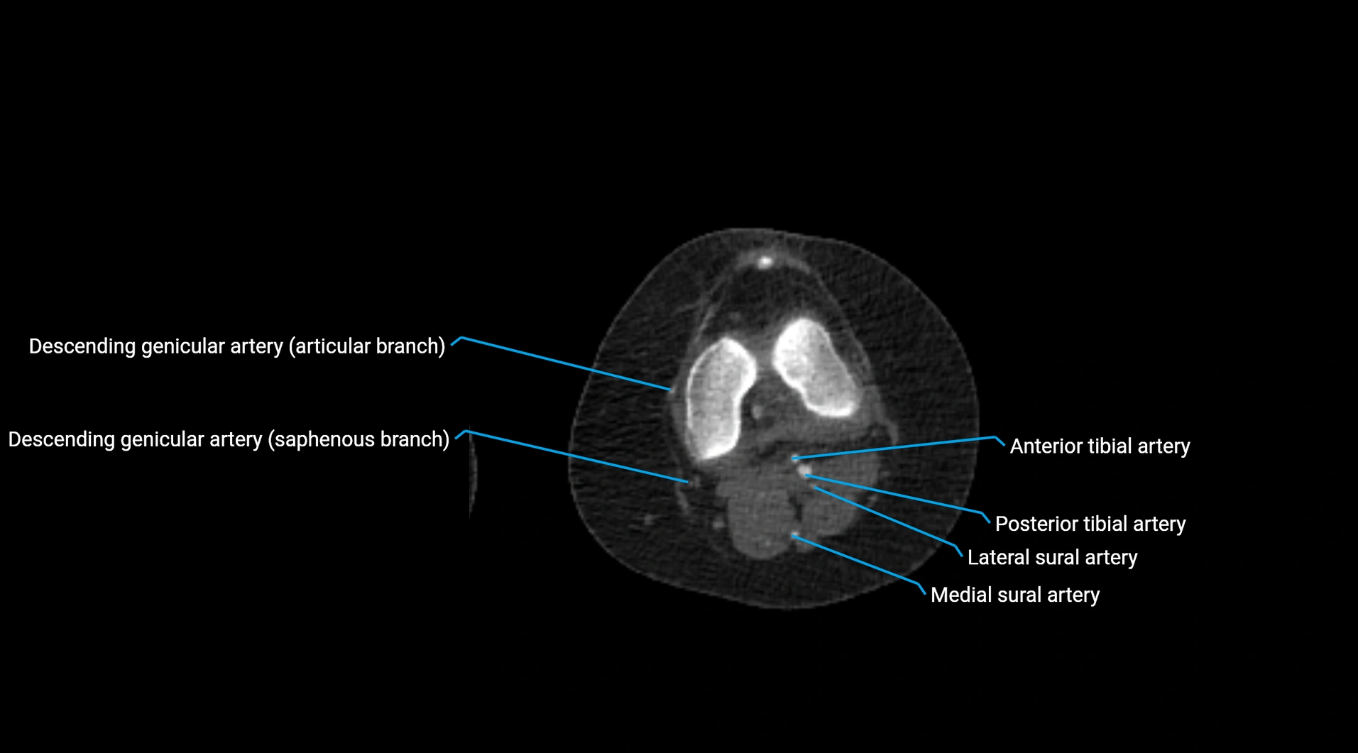 CTA lower limb cross sectional anatomy labelled image _175.webp